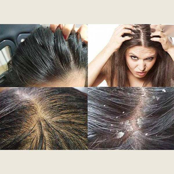 儿童去屑止痒洗发露哪个好?(图1)